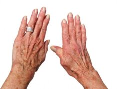 toward new targeted treatments for rheumatoid arthritis